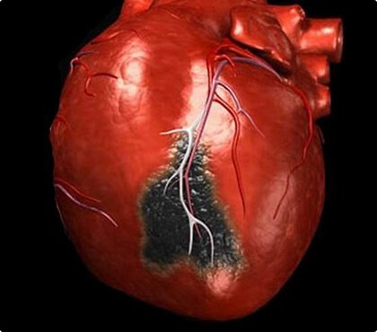 Rischio di infarto miocardico da ipertensione